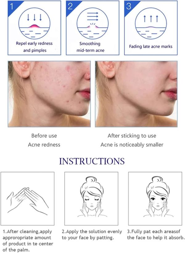 Aichun Beauty Anti-Acne Whitening Serum – Aloe Vera & Salicylic Acid (30ml)