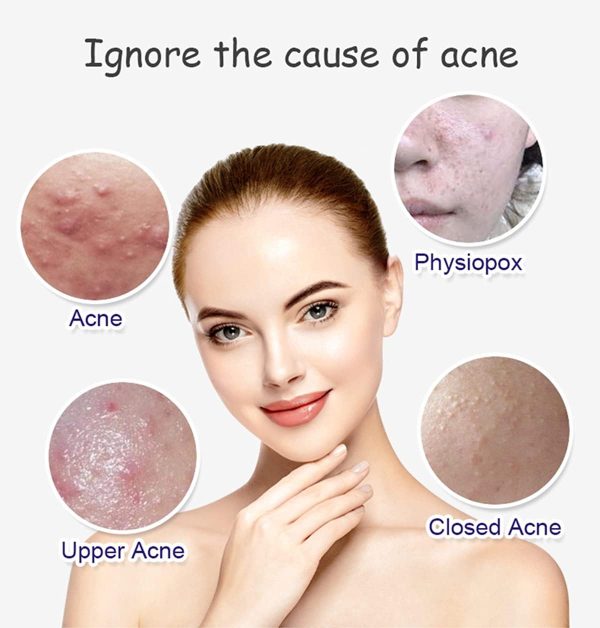 Aichun Beauty Anti-Acne Whitening Serum – Aloe Vera & Salicylic Acid (30ml)