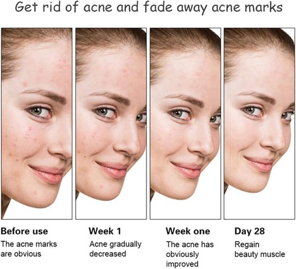 Aichun Beauty Anti-Acne Whitening Serum – Aloe Vera & Salicylic Acid (30ml)